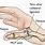 Torn Thumb Ligament