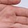 Types of Hand Warts