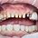 Veneers Filed Teeth