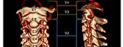 Vertebral Artery V1 V2 V3 V4