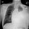 Zator Płucny Na Tomografi