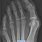 Zone 1 Jones Fracture