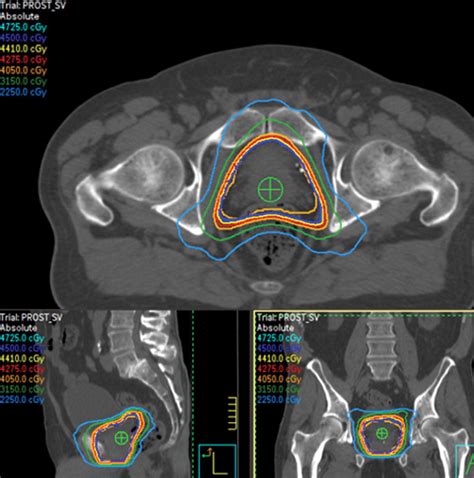 Second Malignancies after Radiation Therapy: Update on Pathogenesis and Cross-sectional Imaging ...