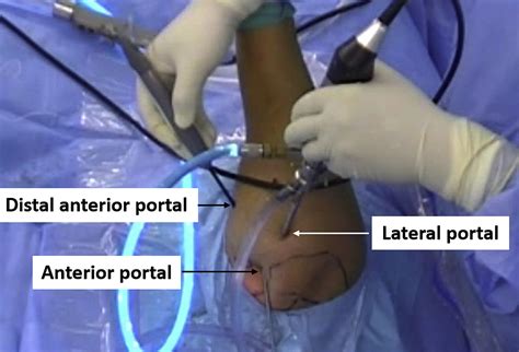 Arthroscopic Outside‐In Rotator Interval Release - Tang - 2020 ...