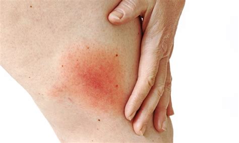 Lyme disease - first symptoms | CM Luxmed Lublin