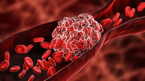 Penumbra’s FDA nod for clot removal tech a win for Boston Scientific ...