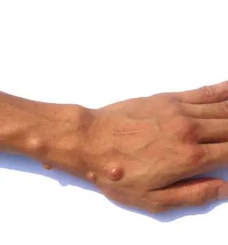 Sebaceous Cysts Explained: What Causes Them and How to Treat Them Naturally