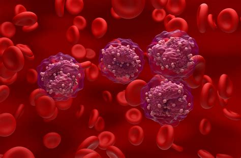 La paradoja genética que explica el origen de la leucemia linfoblástica aguda de células B