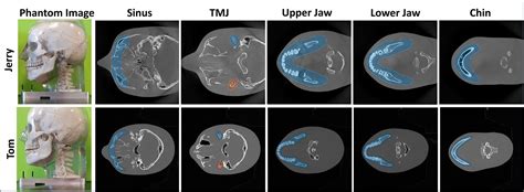 Source-detector trajectory optimization for FOV extension in dental ...