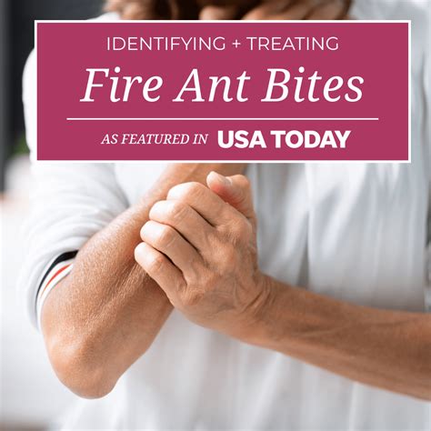 Identifying and Treating Fire Ant Bites | As Seen in USA Today - Mona Dermatology