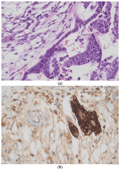 Immature Teratoma of the Ovary—A Narrative Review