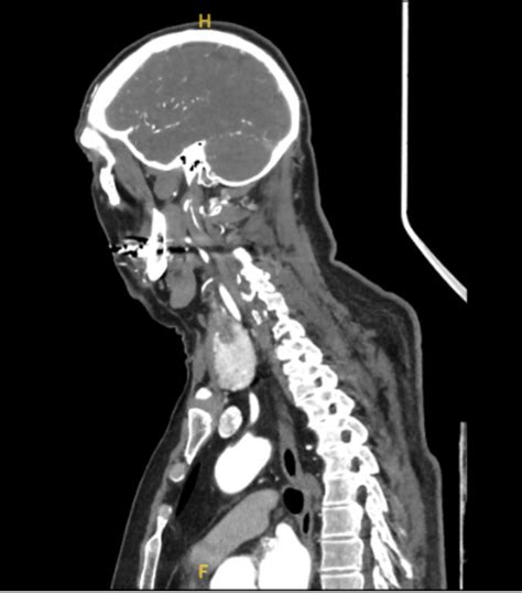 When a ‘pop’ in the neck turns into a stroke: Bilateral ICA dissection after minor trauma ...