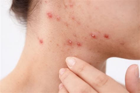 Folliculitis: Causes, Symptoms, and Treatments - Dr Chong Clinic ...