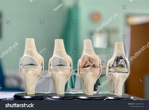 72,349 Recovery After Partial Knee Replacement: Timeline Tips Outcomes Royalty-Free Images ...