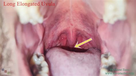 Swollen Eyelid - Symptoms, Treatment, Pictures, Causes | HealDove - Face Surgery