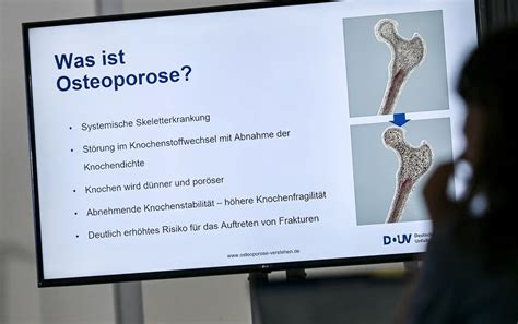 Doctors warn bone loss in women can start silently after 30