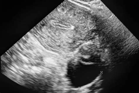 Uterine Fibroids on Ultrasound: Complete Visual Guide