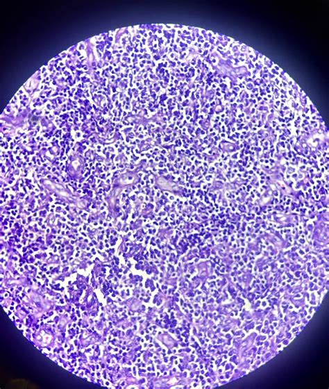 Dr Simran on X: "61 year male #multiple swellings #inguinal lymph node ...
