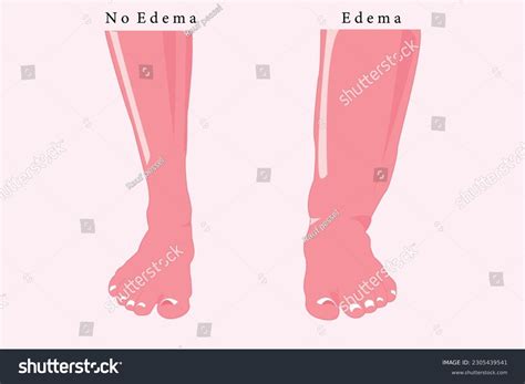 49 Tausend Calf Swelling Comparison Stock-Vektorgrafiken und ...