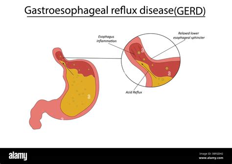 Acid reflux gerd gastroesophageal Stock Vector Images - Alamy