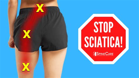 How to Prevent Sciatica Pain Naturally ⋆ ctf.bnsf.com