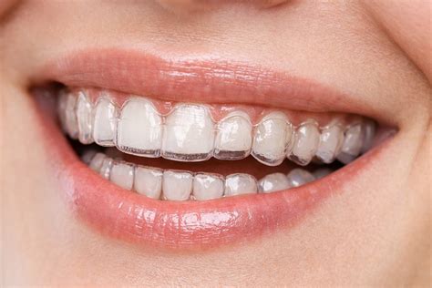 Invisalign Consultation in Brampton: Your Complete Preparation Guide