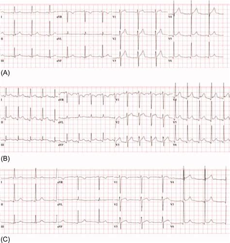 IRIS Presenting as Acute Pericarditis | MDedge