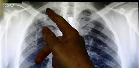 South Africa, Mozambique global tuberculosis hotspots - experts