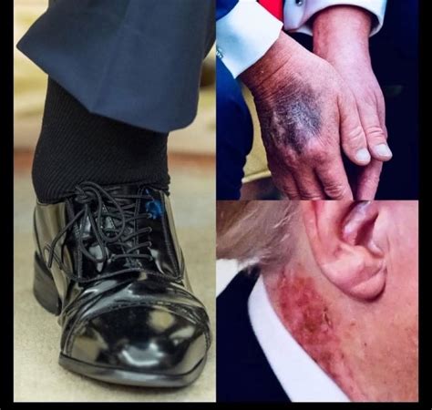 Trump is seriously ill — and not just mentally. At his age, swollen ...