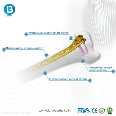 VA Curved Condylar Plate at ₹ 5999/piece | Locking Plates in Vadodara ...