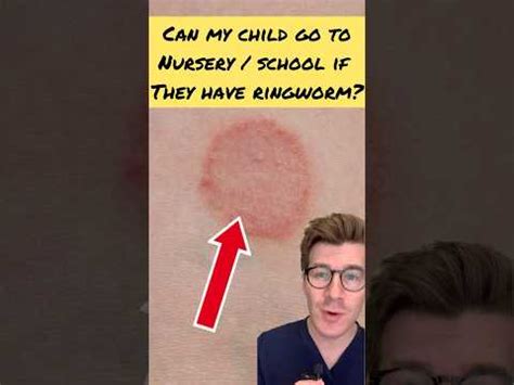 Is Ringworm Dangerous For Babies