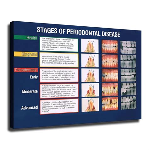 Amazon.de: SFNGXXAG Stages of Periodontal Disease Canvas Poster: Dental ...