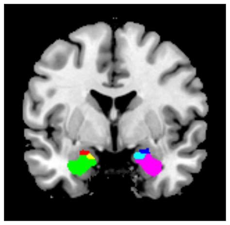 Resting-state functional connectivity of the amygdala subregions in ...