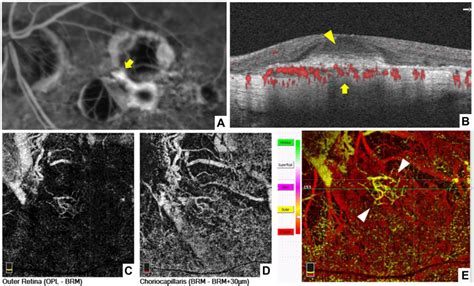 Video Color OCT Angiography for Myopic Choroidal Neovascularization ...