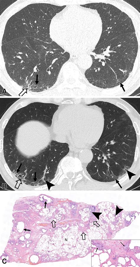 Advances in Concept and Imaging of Interstitial Lung Disease | Radiology