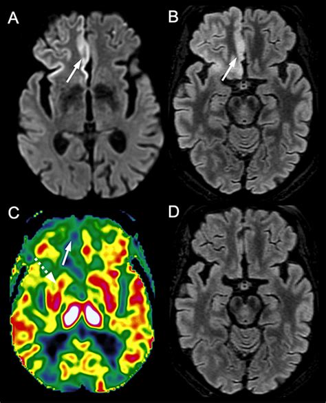 Retrospective Observational Study of Brain MRI Findings in Patients ...