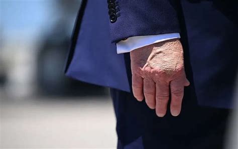 Trump’s bruised hands reignite health debate amid election year