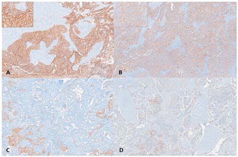 Prognostic and Predictive Significance of Claudin-6 Expression in ...