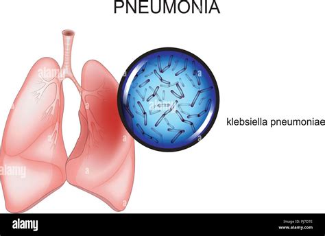 Illness pneumonia Stock Vector Images - Alamy