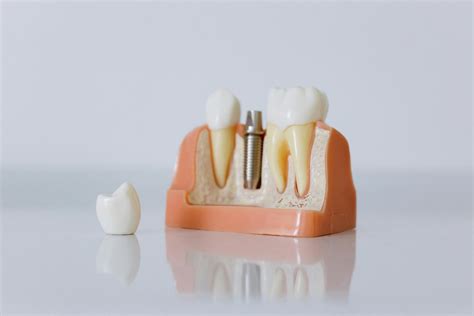 How Do Dental Implants Get Fixed to your Jaw Bone? — Carlton Dental
