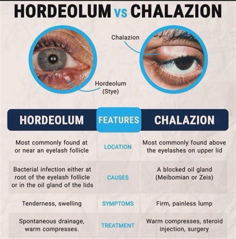 🔍 Clinical reading of the image Localized red, tender swelling at the lower eyelid margin Looks ...