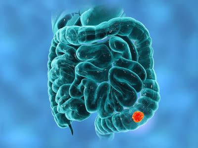 Ascites | Thinking outside the box: a case of unexplained ascites in an ...