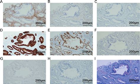 Gastric-Type Endocervical Adenocarcinoma with Ovarian and Lymph Node M ...