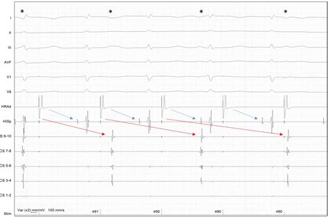Interatrial conduction delay in a young woman mimicking complete atrioventricular block ...