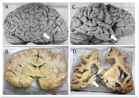 Brain on Overload: Unlocking Hope for Rare Diseases Through Cellular ...