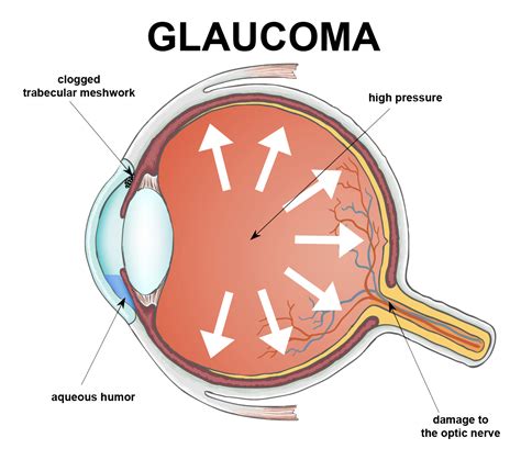 Best Cure For Glaucoma at Beverly Marone blog