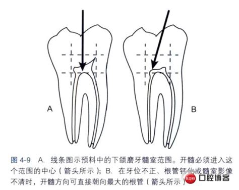 牙髓病4——开髓-昆明牙医赵瑜敏的博客-KQ88口腔博客