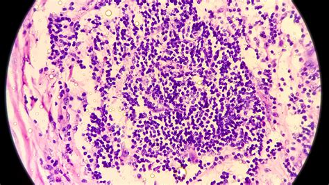Is Hidradenitis Suppurativa Contagious?