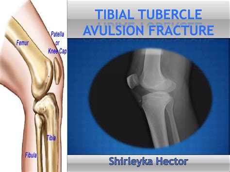 Tibial Tubercle Avulsion Fracture Powerpoint (1) | PPTX