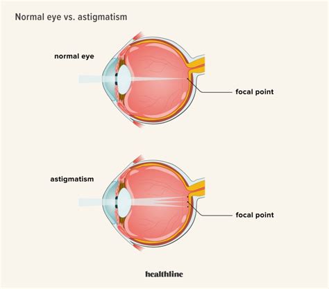Can Astigmatism Be Fixed with Glasses?